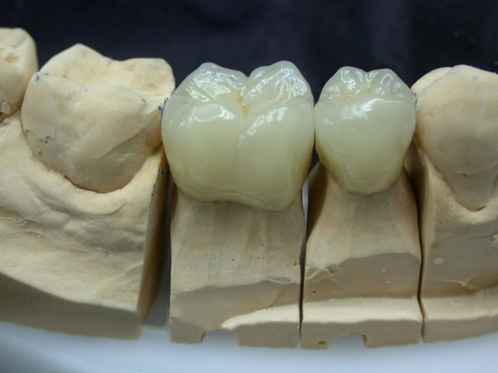 Proteza dinților superiori anteriori