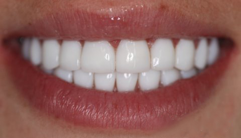 Proteza dinților superiori anteriori