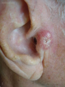 Рак вуха симптоми і перші ознаки пухлини в вусі