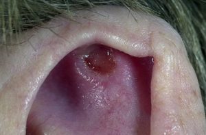 Рак вуха симптоми і перші ознаки пухлини в вусі