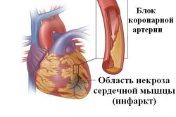 Reabilitare după infarct miocardic și stenting