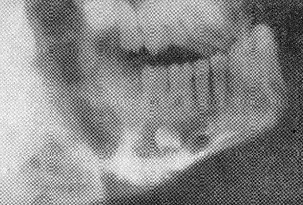Ретикулярна саркома - пухлини м'яких тканин щелепно-лицевої ділянки та шиї - стоматологія дитячого