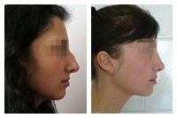 Rinoplastia (nas chirurgie plastică), 