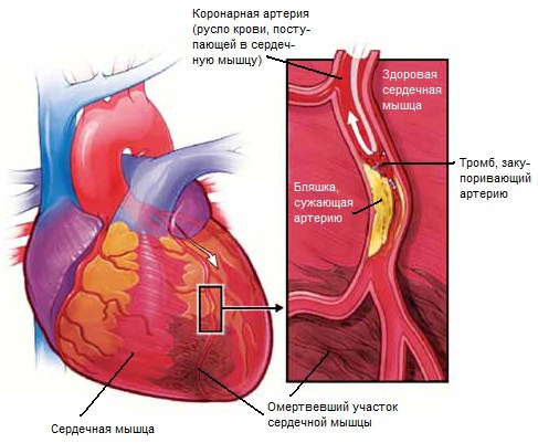 Simptomele infarctului miocardic, de care trebuie să știți, regulile sănătății și longevitatea