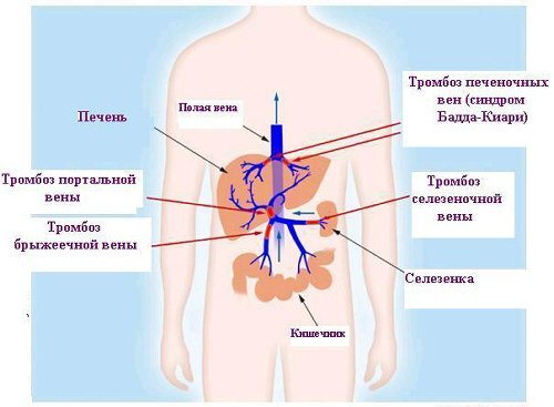 Sindromul Badda Chiari