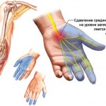 Синдром зап'ястного каналу (тунельний) симптоми, лікування