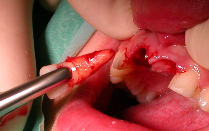 Скільки зубів можна вирвати за одне відвідування стоматолога