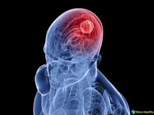 Simptomele vaselor cerebrale, tratamentul, prevenirea