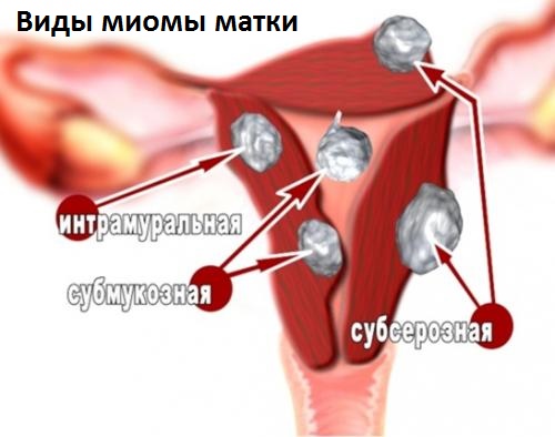 Сучасне лікування міоми матки за кордоном