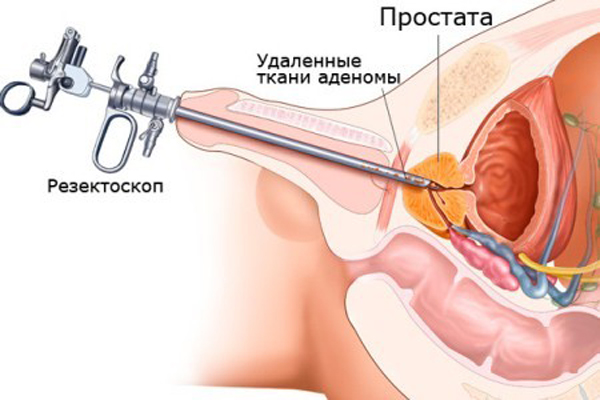 Tratamentul pentru adenomul prostatic