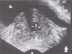 Trusi al glandei prostatice - semne ecografice ale chisturilor și prostatelor de prostată