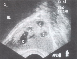 Trusi al glandei prostatice - semne ecografice ale chisturilor și prostatelor de prostată