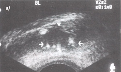 Trusi al glandei prostatice - semne ecografice ale chisturilor și prostatelor de prostată