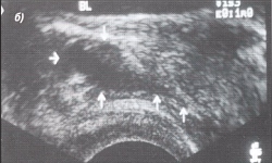 Trusi al glandei prostatice - semne ecografice ale chisturilor și prostatelor de prostată