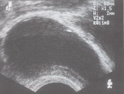 ТРУЗІ передміхурової залози - ехографічні ознаки кіст передміхурової залози і