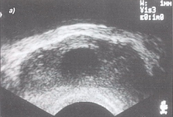 Trusi al glandei prostatice - semne ecografice ale chisturilor și prostatelor de prostată