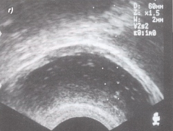 pleomorphic adenoma treatment of choice íj fájdalom prosztatitis