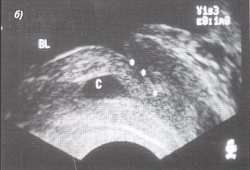 Trusi al glandei prostatice - semne ecografice ale chisturilor și prostatelor de prostată