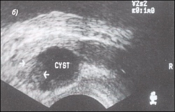 Trusi al glandei prostatice - semne ecografice ale chisturilor și prostatelor de prostată