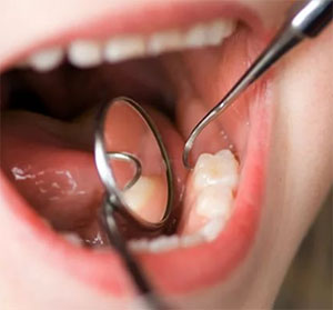 Extragerea sau restaurarea dinților