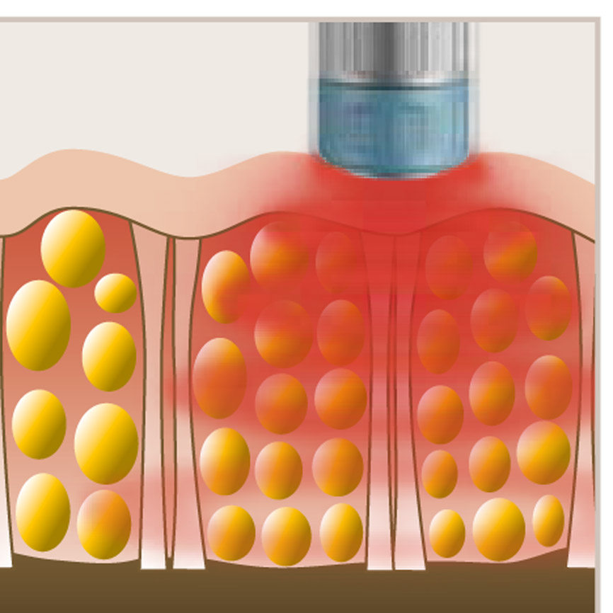 Recenzii privind terapia Shockwave