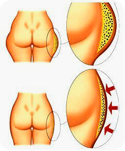 Recenzii privind terapia Shockwave