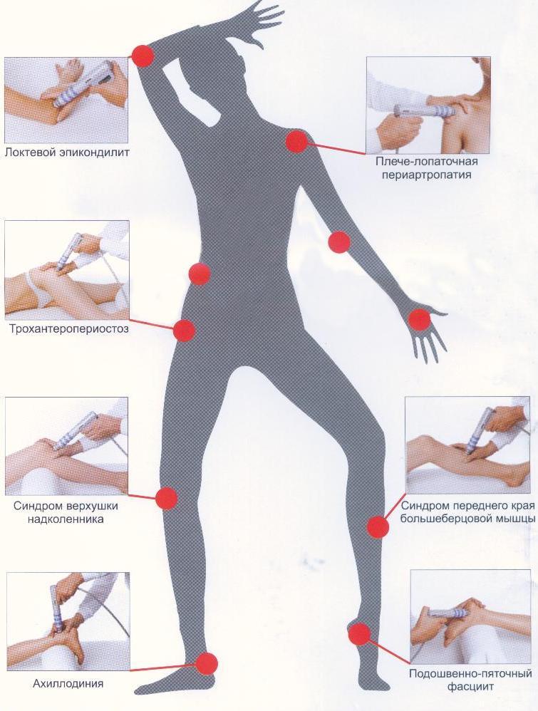 Recenzii privind terapia Shockwave