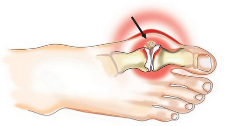 Sokk-hullám terápia hallux valgus