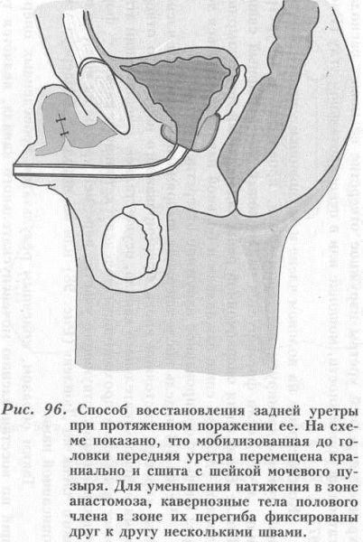 Urethra - operațiuni de restabilire a integrității