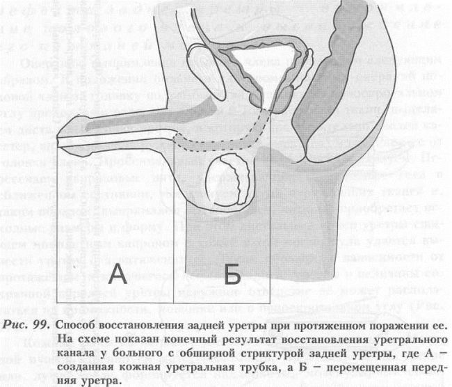 Urethra - operațiuni de restabilire a integrității