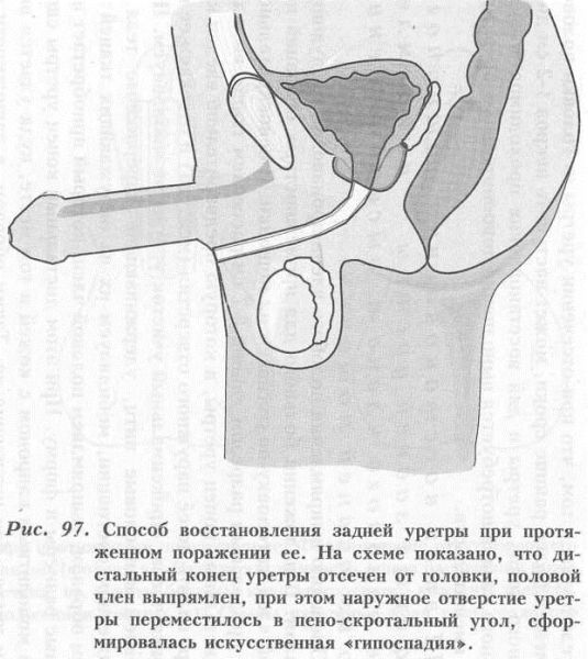 Urethra - operațiuni de restabilire a integrității