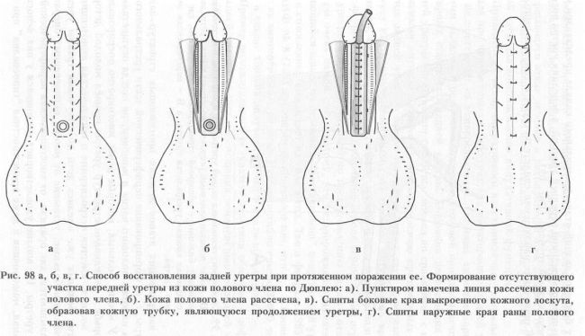 Urethra - operațiuni de restabilire a integrității