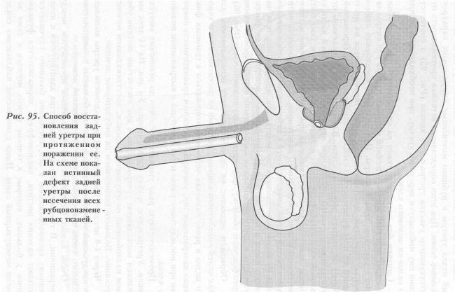 Urethra - operațiuni de restabilire a integrității