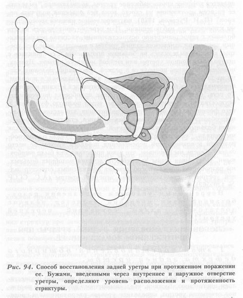 Urethra - operațiuni de restabilire a integrității