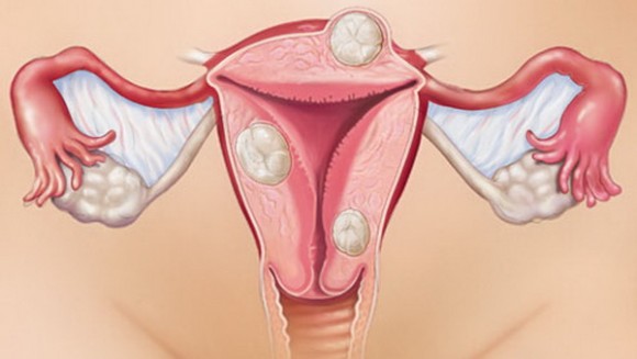 Tratamentul fibromilor uterici nodali, cauze, simptome de formă