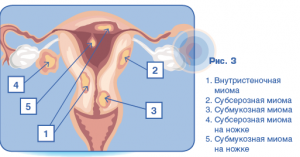 Вузлова міома матки лікування, причини, симптоми форми