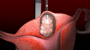 Tratamentul fibromilor uterici nodali, cauze, simptome de formă