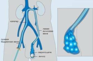 Vene varicoase ale cordonului spermatic la stânga, simptomele de varicocel