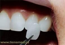 Вініри - облицювання зубів порцеляною (це корисно знати)