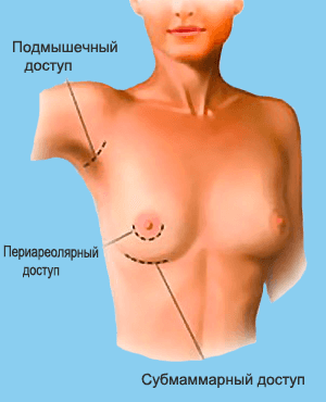 Виконуємо збільшення грудей