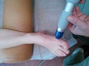 Halyus valgus (csontok a láb) (halyus) Halyus valgus (csontok a láb)