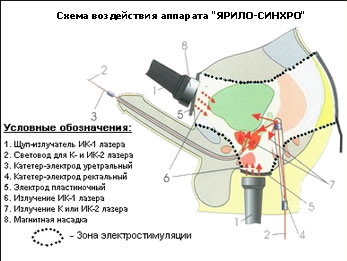 Ярило - синхро 02 урологічний електролазерний терапевтичний апарат (аелту 02)