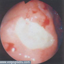 Peptic ulcer din punct de vedere al unui medic endoscopic, partea a doua