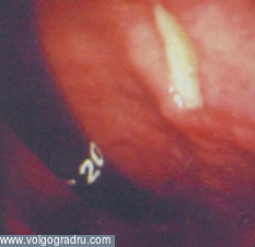 Peptic ulcer din punct de vedere al unui medic endoscopic, partea a doua