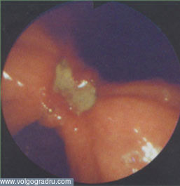 Peptic ulcer din punct de vedere al unui medic endoscopic, partea a doua