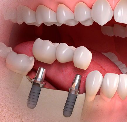 Implanturi dentare fotografie, recenzii, preț, ghid dentar