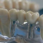 Implanturi dentare fotografie, recenzii, preț, ghid dentar