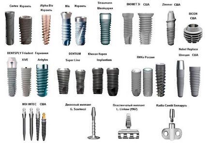 Implanturi dentare fotografie, recenzii, preț, ghid dentar