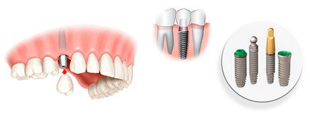 Implanturi dentare fotografie, recenzii, preț, ghid dentar