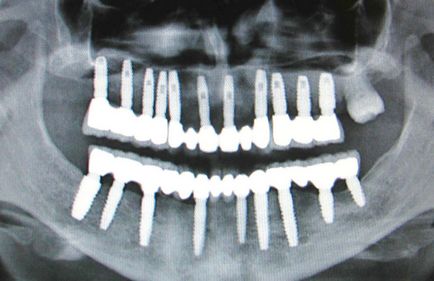 Implanturi dentare fotografie, recenzii, preț, ghid dentar